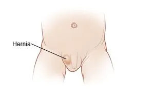 Gambar Hernia pada Anak Laki-laki